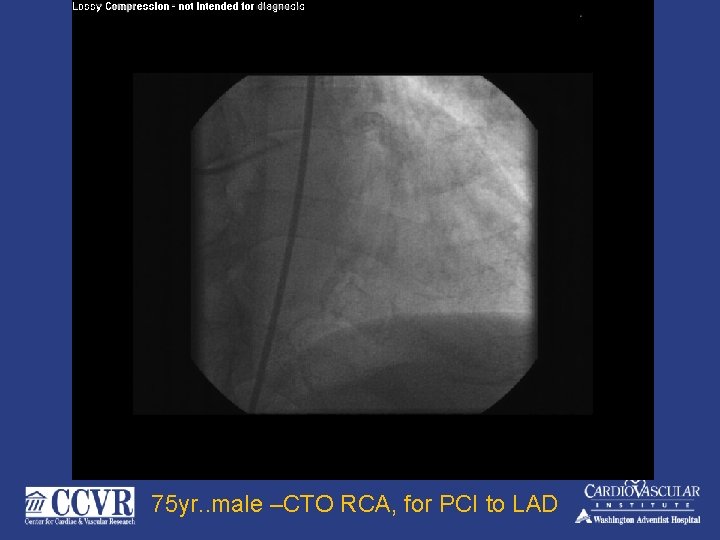 75 yr. . male –CTO RCA, for PCI to LAD 