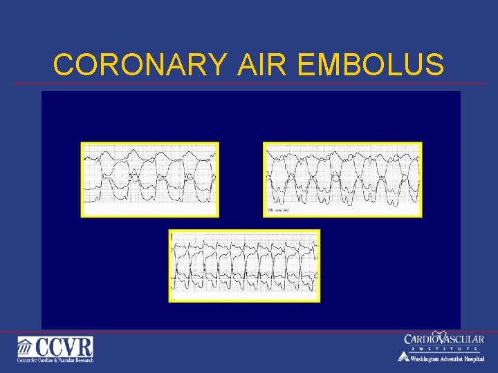CORONARY AIR EMBOLUS 