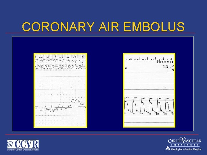 CORONARY AIR EMBOLUS 