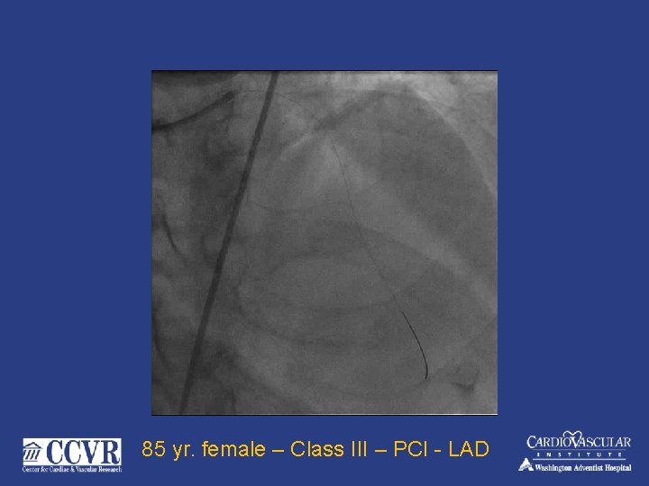 85 yr. female – Class III – PCI - LAD 