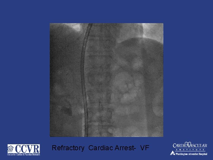 Refractory Cardiac Arrest- VF 