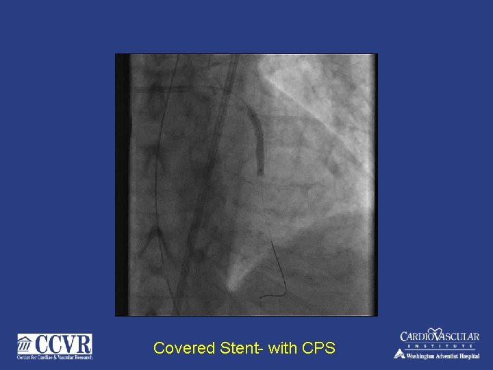Covered Stent- with CPS 