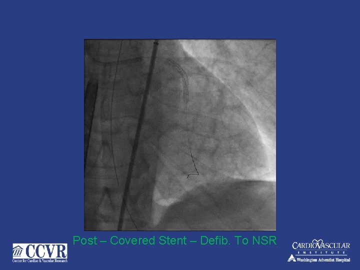 Post – Covered Stent – Defib. To NSR 