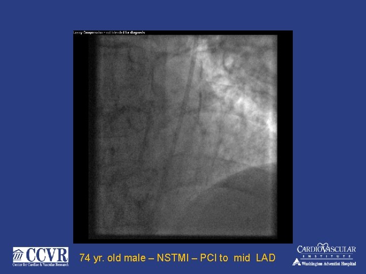 74 yr. old male – NSTMI – PCI to mid LAD 