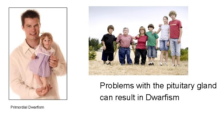 Problems with the pituitary gland can result in Dwarfism Primordial Dwarfism 