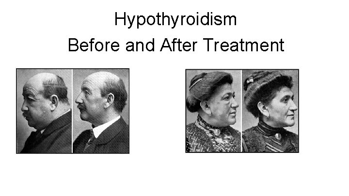 Hypothyroidism Before and After Treatment 