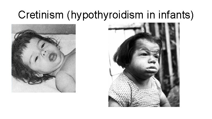 Cretinism (hypothyroidism in infants) 