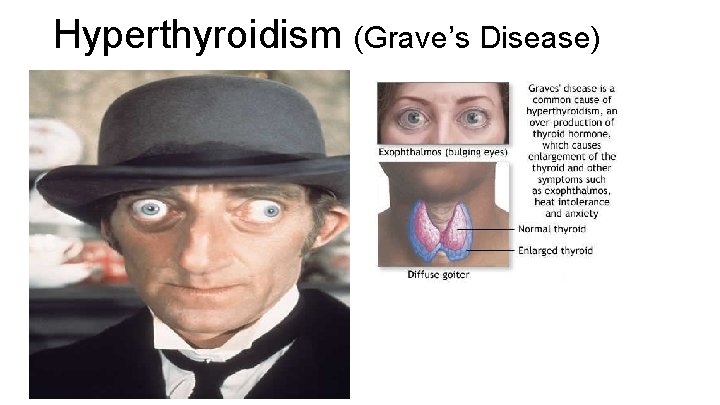 Hyperthyroidism (Grave’s Disease) 