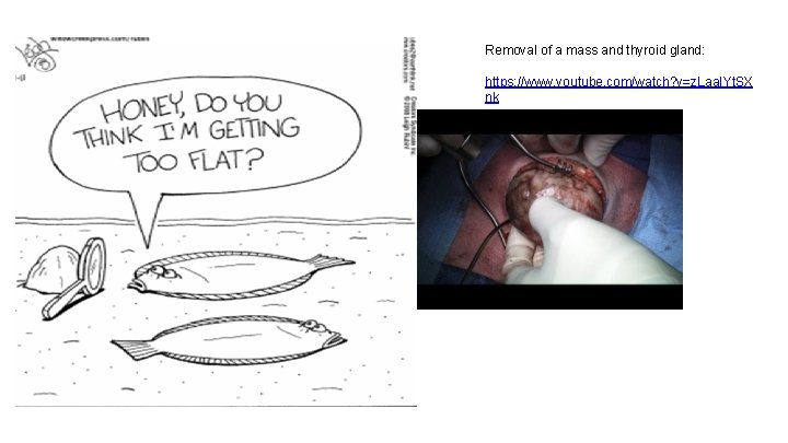 Removal of a mass and thyroid gland: https: //www. youtube. com/watch? v=z. Laa. IYt.