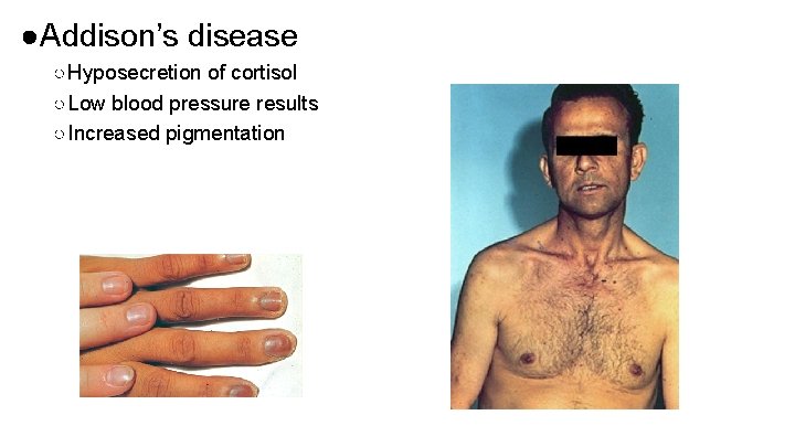 ●Addison’s disease ○ Hyposecretion of cortisol ○ Low blood pressure results ○ Increased pigmentation