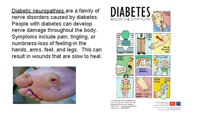 Diabetic neuropathies are a family of nerve disorders caused by diabetes. People with diabetes