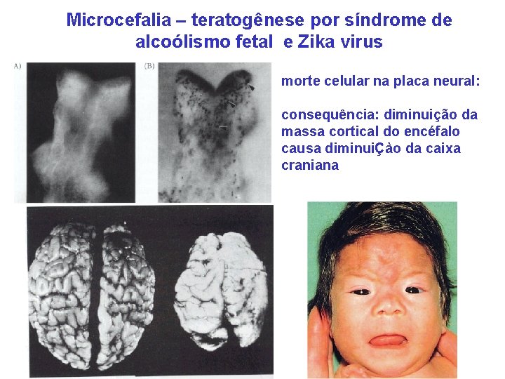 Microcefalia – teratogênese por síndrome de alcoólismo fetal e Zika virus morte celular na