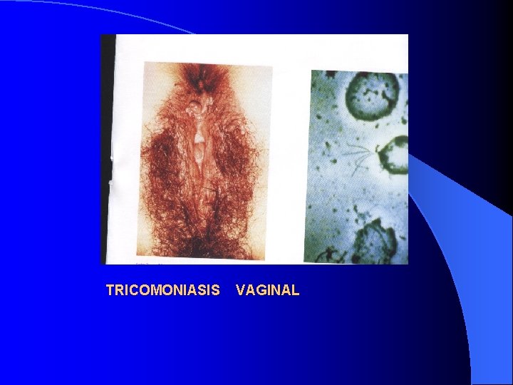 TRICOMONIASIS VAGINAL 
