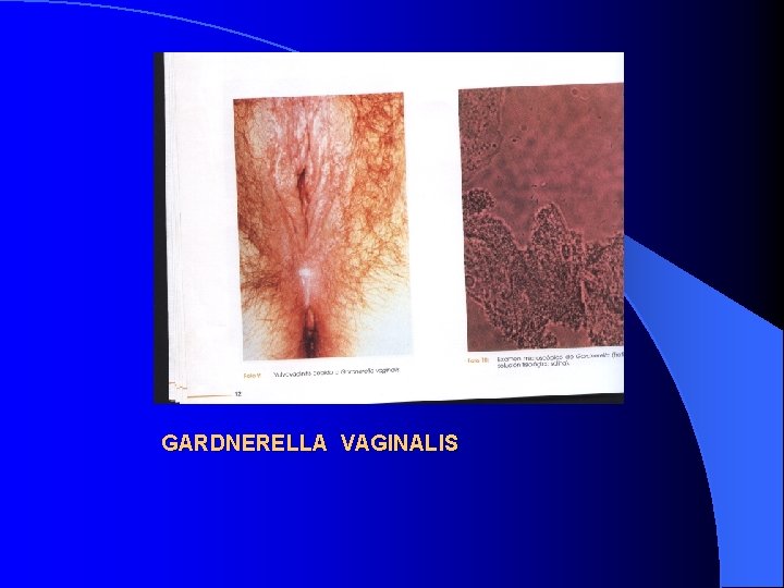 GARDNERELLA VAGINALIS 