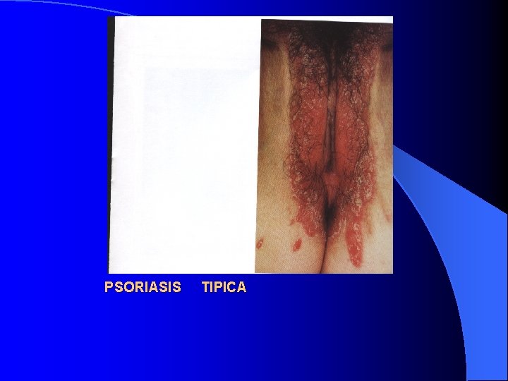 PSORIASIS TIPICA 