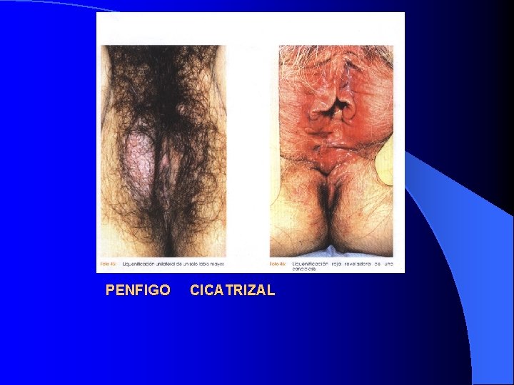 PENFIGO CICATRIZAL 