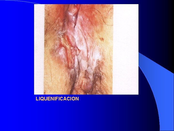 LIQUENIFICACION 