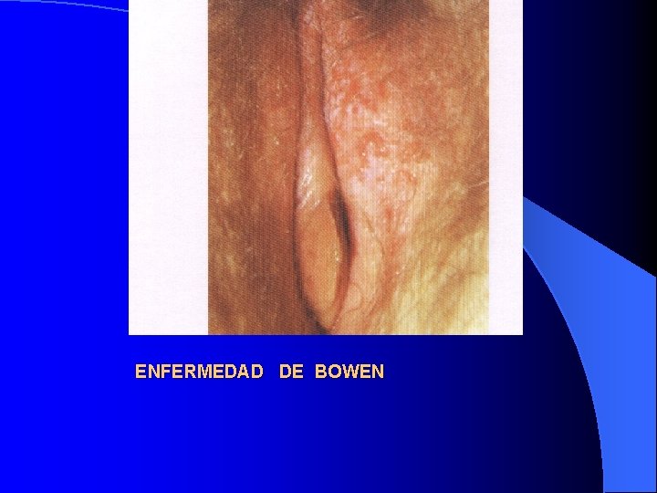 ENFERMEDAD DE BOWEN 