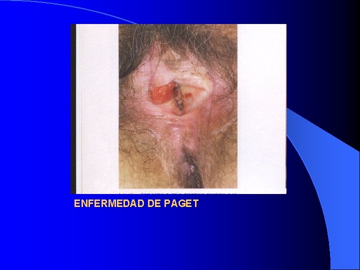 ENFERMEDAD DE PAGET 