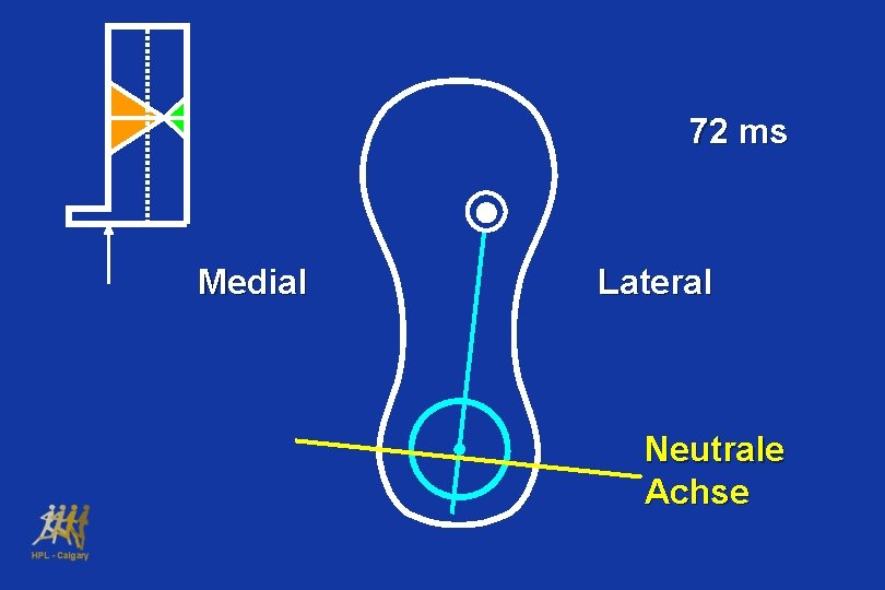 72 ms Medial Lateral Neutrale Achse 