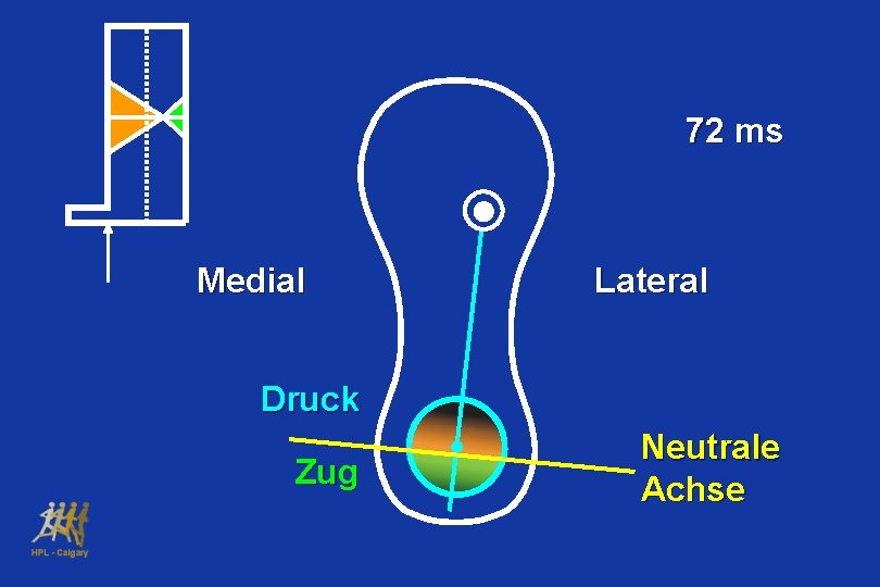 72 ms Medial Lateral Druck Zug Neutrale Achse 