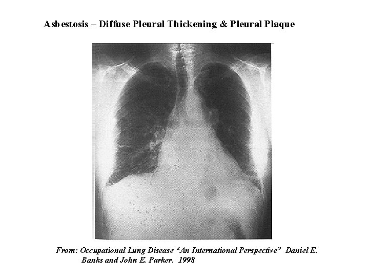 Asbestosis – Diffuse Pleural Thickening & Pleural Plaque From: Occupational Lung Disease “An International