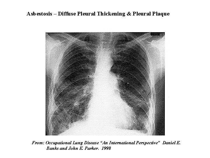 Asbestosis – Diffuse Pleural Thickening & Pleural Plaque From: Occupational Lung Disease “An International