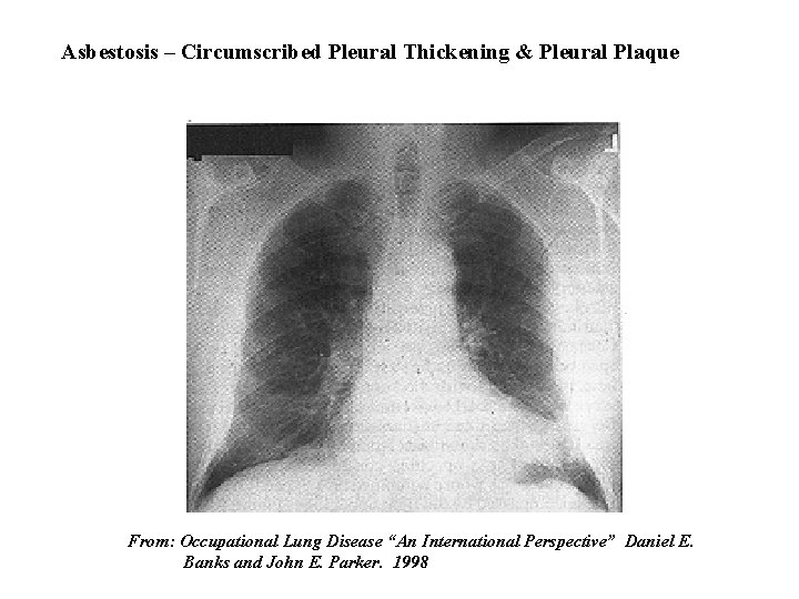 Asbestosis – Circumscribed Pleural Thickening & Pleural Plaque From: Occupational Lung Disease “An International