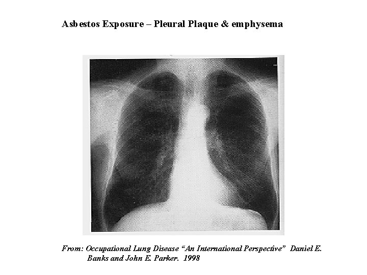 Asbestos Exposure – Pleural Plaque & emphysema From: Occupational Lung Disease “An International Perspective”