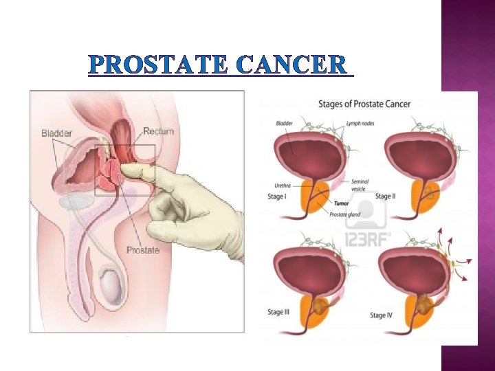 PROSTATE CANCER 