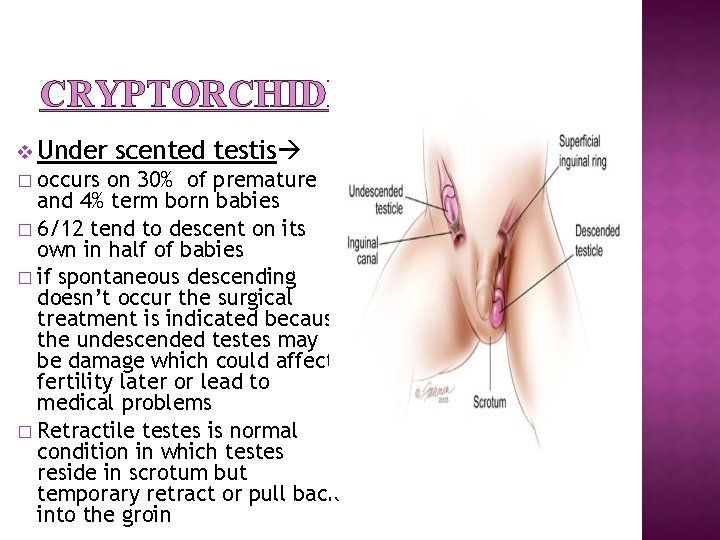 CRYPTORCHIDISM v Under scented testis occurs on 30% of premature and 4% term born