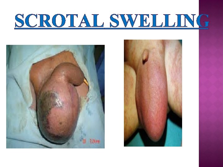 SCROTAL SWELLING 