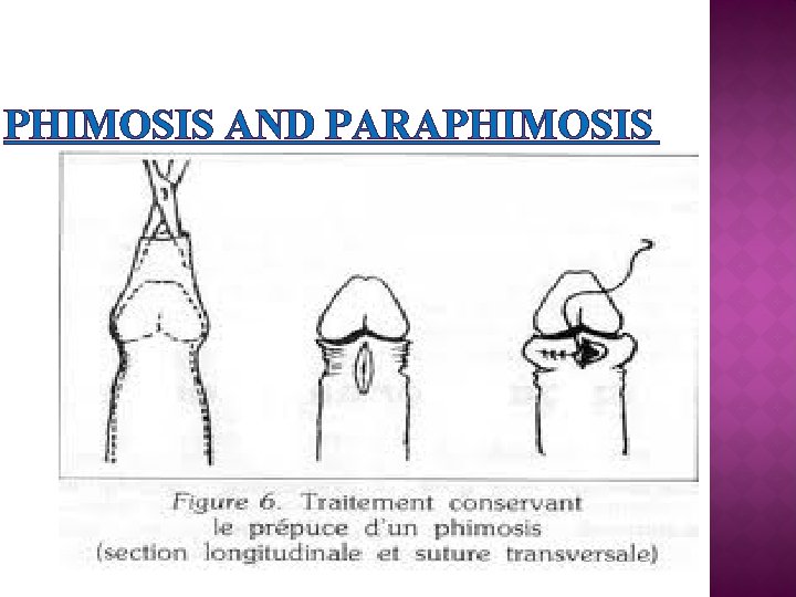 PHIMOSIS AND PARAPHIMOSIS 