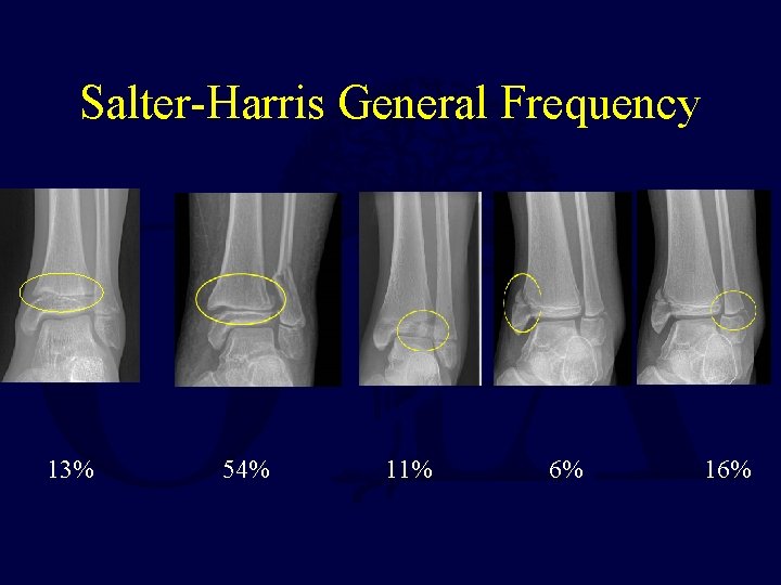 Salter-Harris General Frequency 13% 54% 11% 6% 16% 
