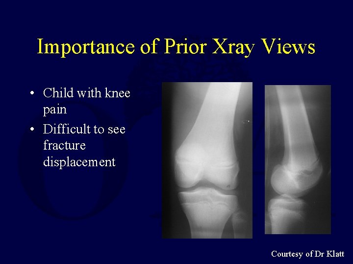 Importance of Prior Xray Views • Child with knee pain • Difficult to see