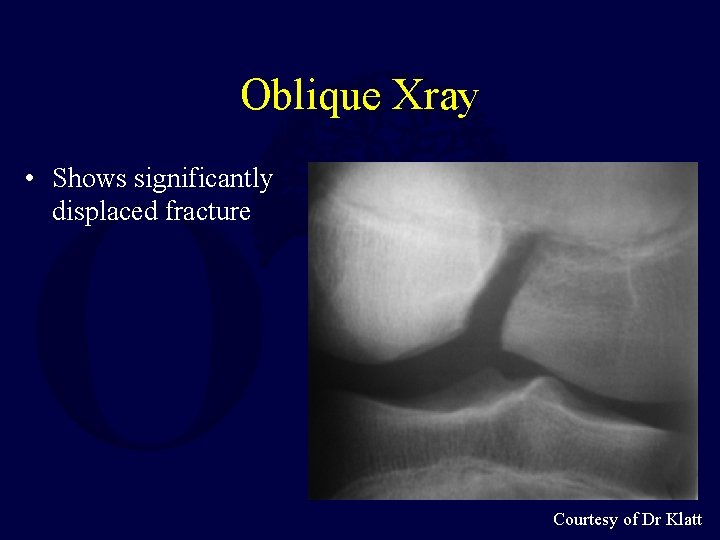 Oblique Xray • Shows significantly displaced fracture Courtesy of Dr Klatt 
