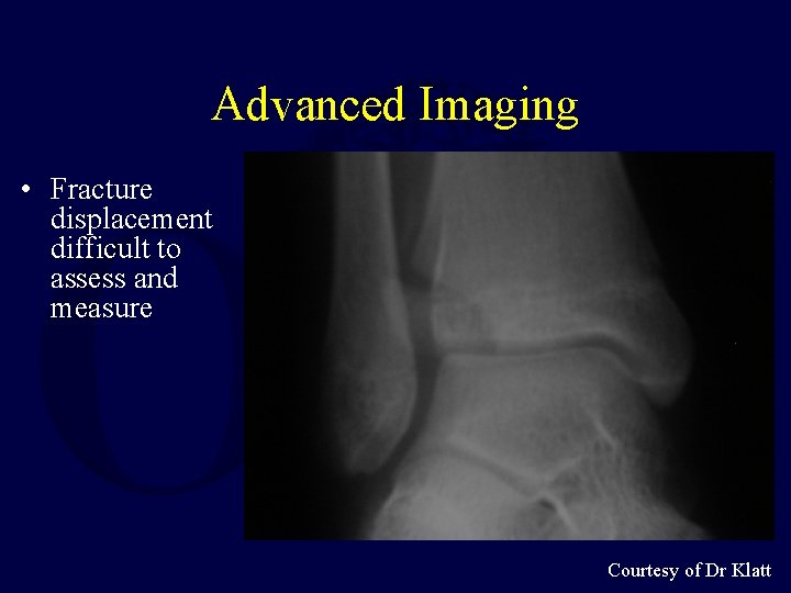Advanced Imaging • Fracture displacement difficult to assess and measure Courtesy of Dr Klatt