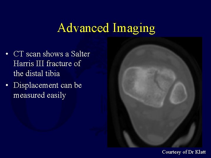 Advanced Imaging • CT scan shows a Salter Harris III fracture of the distal
