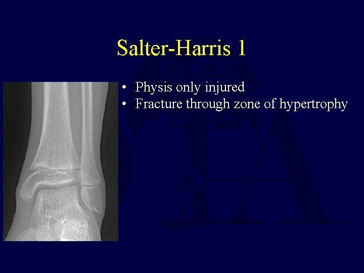 Salter-Harris 1 • Physis only injured • Fracture through zone of hypertrophy 