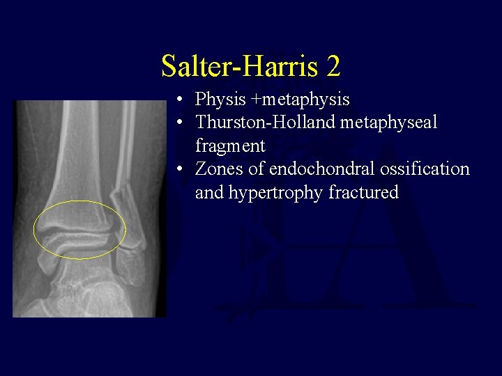 Salter-Harris 2 • Physis +metaphysis • Thurston-Holland metaphyseal fragment • Zones of endochondral ossification