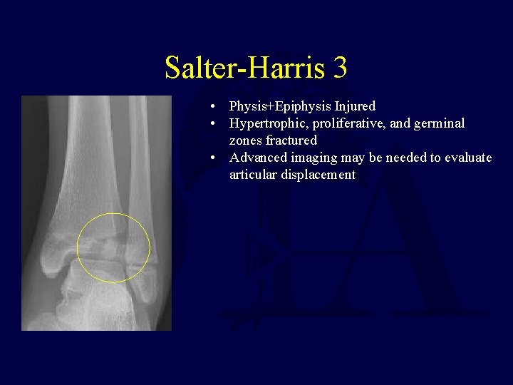 Salter-Harris 3 • Physis+Epiphysis Injured • Hypertrophic, proliferative, and germinal zones fractured • Advanced