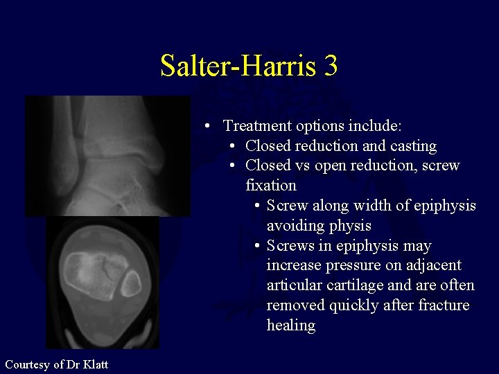 Salter-Harris 3 • Treatment options include: • Closed reduction and casting • Closed vs