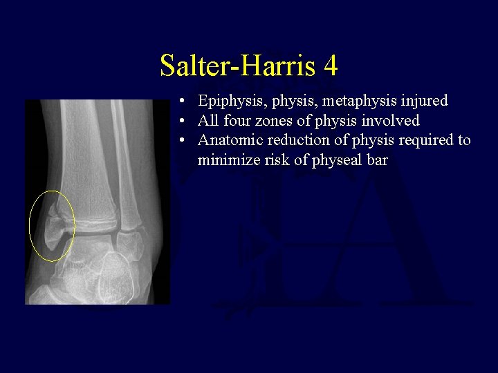 Salter-Harris 4 • Epiphysis, metaphysis injured • All four zones of physis involved •