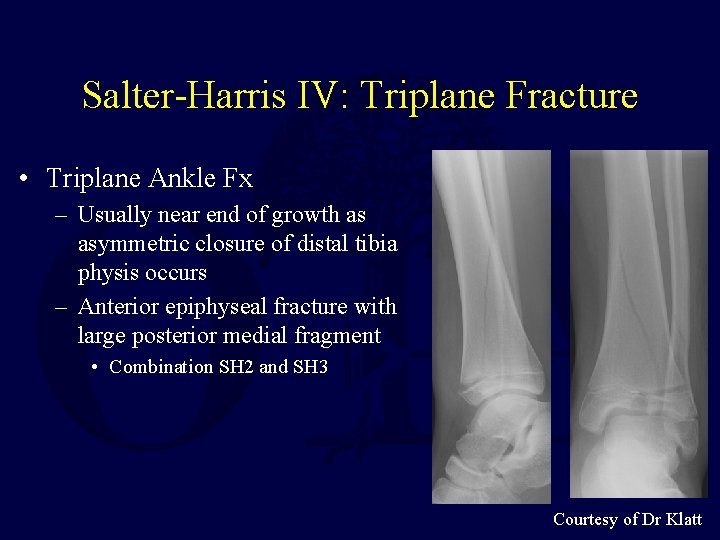 Salter-Harris IV: Triplane Fracture • Triplane Ankle Fx – Usually near end of growth
