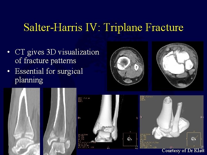 Salter-Harris IV: Triplane Fracture • CT gives 3 D visualization of fracture patterns •
