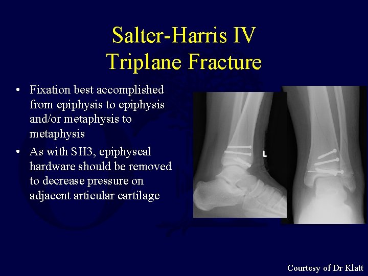 Salter-Harris IV Triplane Fracture • Fixation best accomplished from epiphysis to epiphysis and/or metaphysis