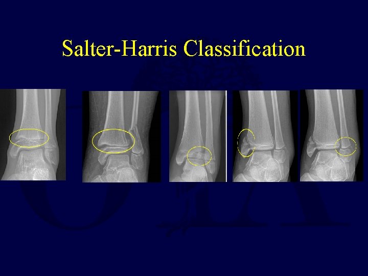 Salter-Harris Classification 