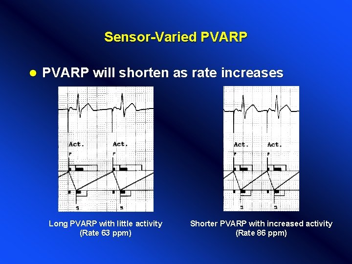 Sensor-Varied PVARP l PVARP will shorten as rate increases Long PVARP with little activity