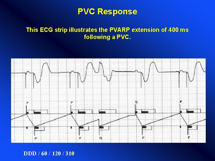 PVC Response This ECG strip illustrates the PVARP extension of 400 ms following a PVC Response This ECG strip illustrates the PVARP extension of 400 ms following a