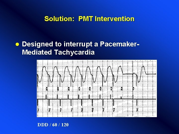 Solution: PMT Intervention l Designed to interrupt a Pacemaker. Mediated Tachycardia DDD / 60